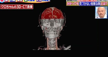 主治医が見つかる診療所 芸能人人間ドックSP クロちゃんの健康診断 血管3D-CT画像