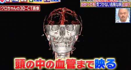 主治医が見つかる診療所 芸能人人間ドックSP クロちゃんの健康診断 頭蓋骨3D-CT画像