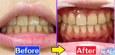 ジロジロ有吉sp 喫煙者ヒコロヒー 薄幸の歯のホワイトニング効果比較 自宅vsクリニックの差は