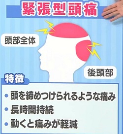 NHKあさイチ マスク不調改善SP マスク頭痛は2タイプに分けて改善！緊張型頭痛の特徴