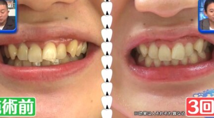 ジロジロ有吉SP 喫煙者ヒコロヒー＆薄幸の歯のホワイトニング効果比較。3回施術後の薄幸のビフォーアフター画像