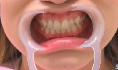 ジロジロ有吉SP 喫煙者ヒコロヒー＆薄幸の歯のホワイトニング効果比較。3回施術後の薄幸の歯の白さ
