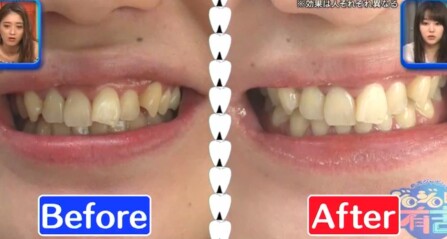 ジロジロ有吉SP 喫煙者ヒコロヒー＆薄幸の歯のホワイトニング効果比較。薄幸のビフォーアフター画像