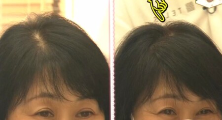 Nhkあさイチ 女性の薄毛の原因と対策 薄毛治療 食べ物や薄毛専門美容院の髪型テクニック