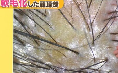 NHKあさイチ 女性の薄毛の原因と対策 更年期で起こる薄毛の画像