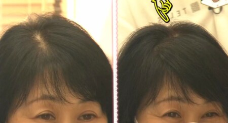 NHKあさイチ 女性の薄毛の原因と対策 薄毛専門美容院の髪型テクニック ジグザグ分け目消し