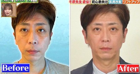 今夜くらべてみました 後藤輝基の美肌プロジェクト第1弾 ハイドラフェイシャル エンディメッド