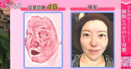 あさイチ シミ対策特集 皮膚科先生 50代の日比野佐和子先生の肌