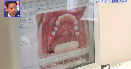 錦鯉長谷川の歯の治療 インプラントの頭を出す2回法手術 ロンハー