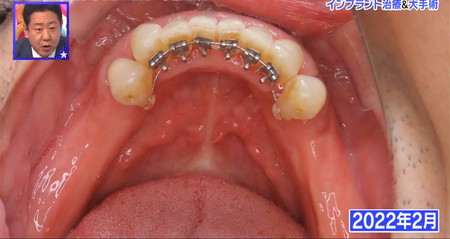 錦鯉長谷川の歯の治療 下の歯の矯正過程 ロンハー