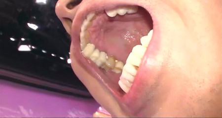錦鯉長谷川の歯の治療後 上の奥歯 ロンハー
