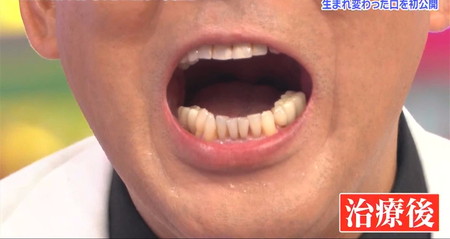 錦鯉長谷川の歯の治療後の画像 ロンハー