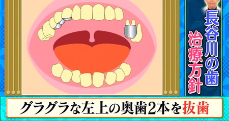 錦鯉長谷川の歯の治療方針 奥歯2本は抜歯 ロンハー