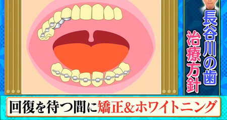 錦鯉長谷川の歯の治療方針 矯正とホワイトニング ロンハー